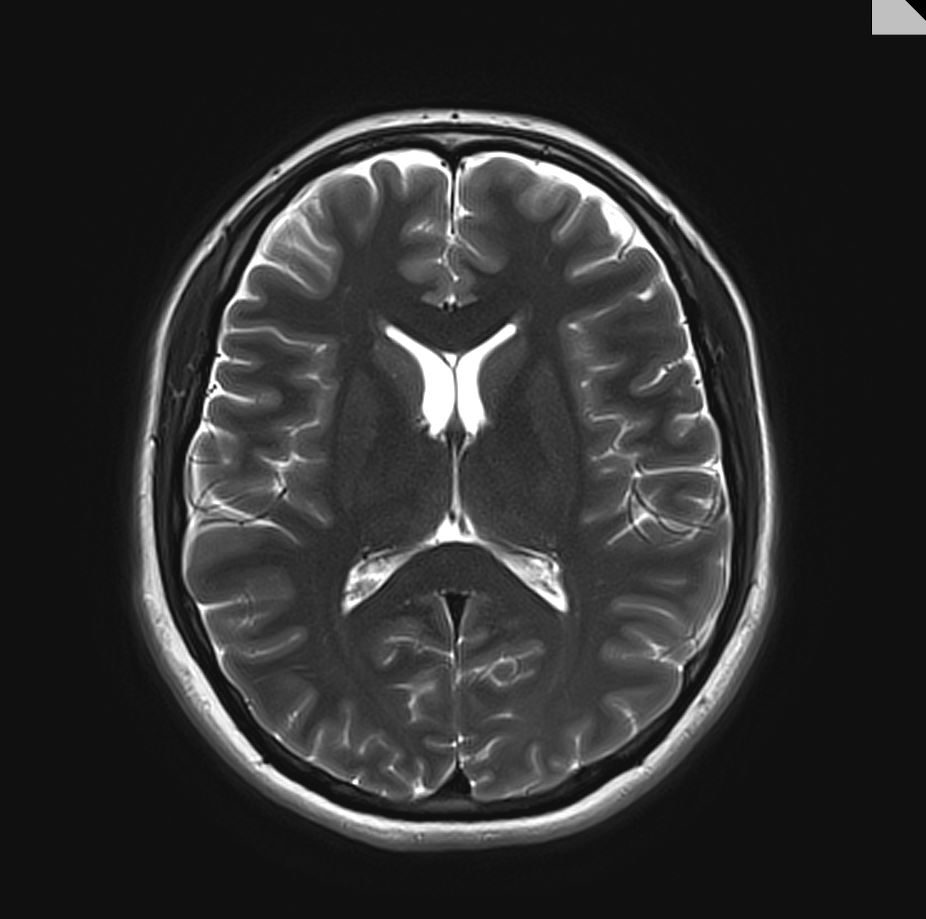 AI software tool aims to spot early signs of dementia from brain scans