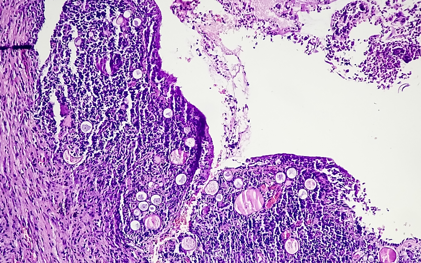 Phenotyping endometriosis: how big data can close the knowledge gap