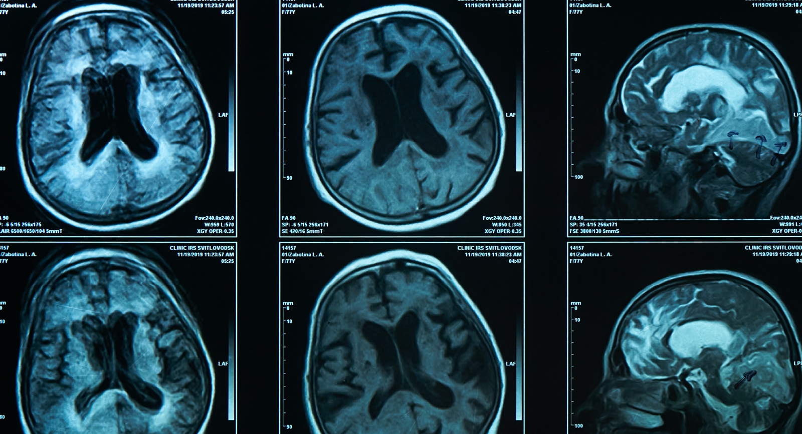 NEURii: New global collaboration to transform dementia care