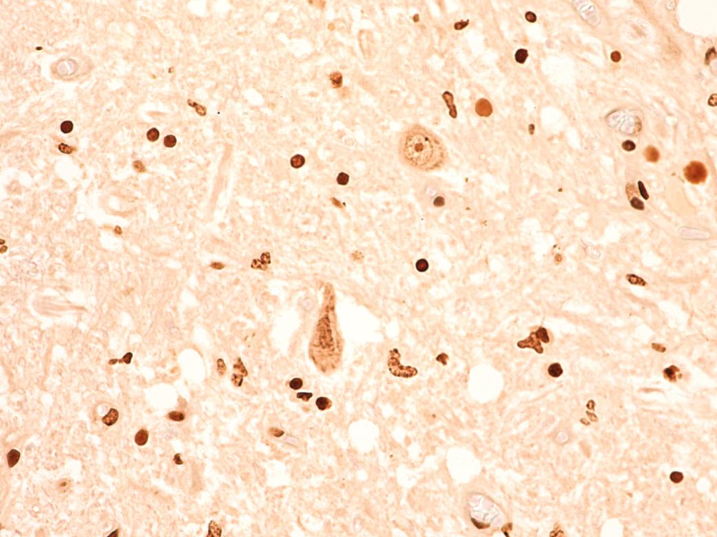 Aptamers for the early detection and monitoring of neurodegenerative diseases
